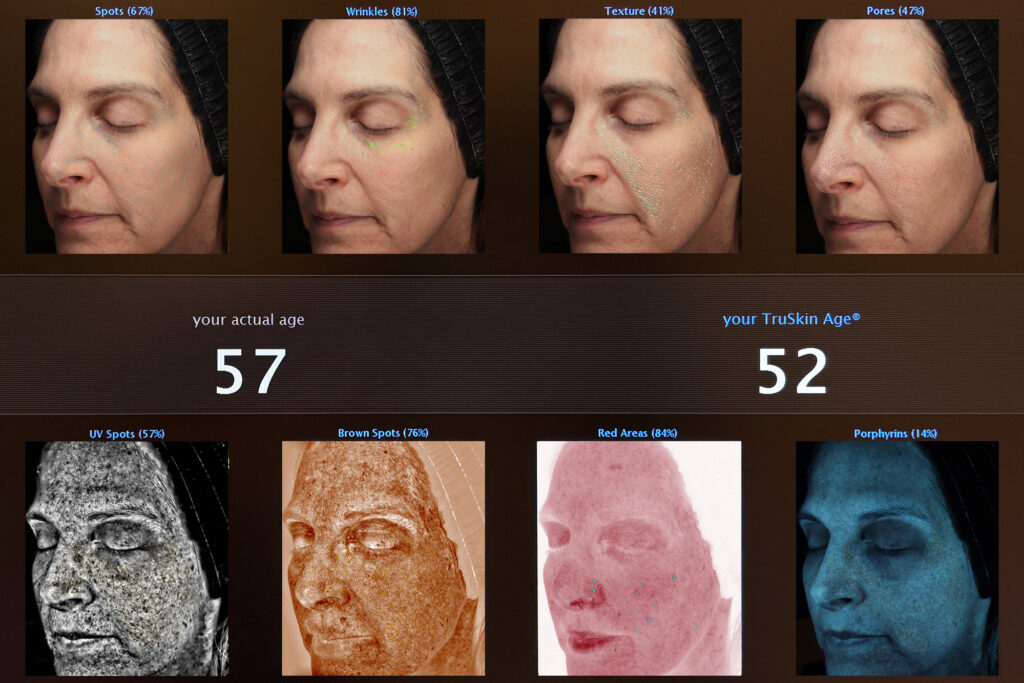 Von & Co Medical Aesthetics Studio guest VISIA skin scan results 3 months after one Halo treatment shows her TrueSkin Age is now 52, five years younger than her chronological age.