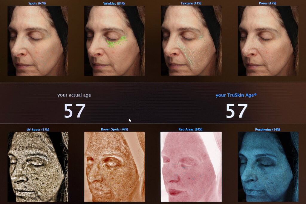 Von & Co Medical Aesthetics Studio guest VISIA skin scan results before her first Halo treatment.