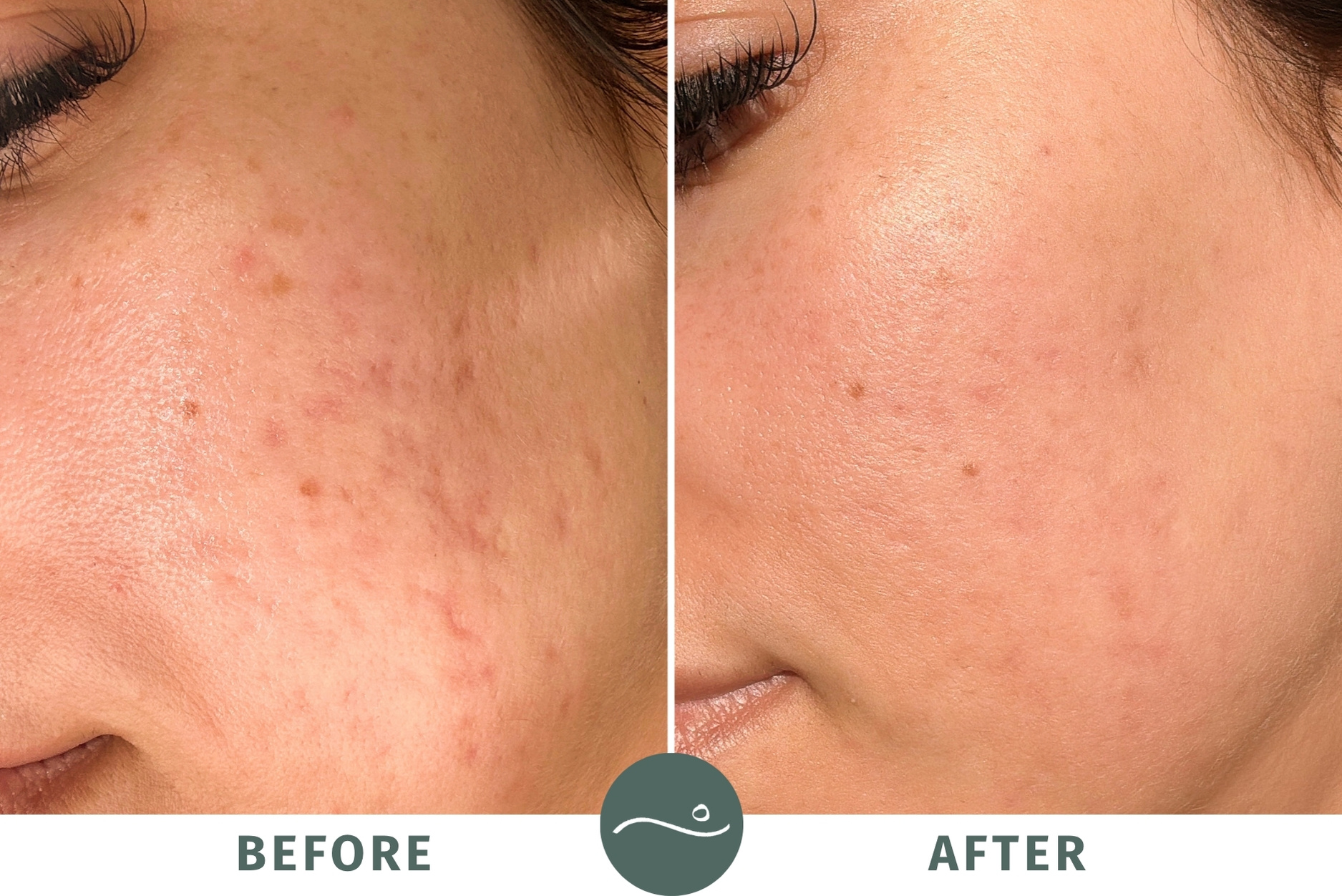 Laser skin resurfacing is the best treatment for acne scars, dark spots, redness, and rough skin texture.