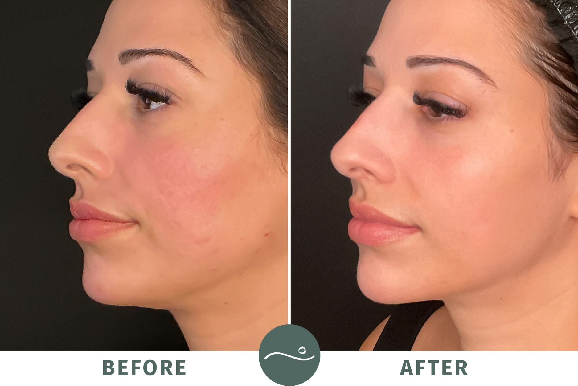 Facial balancing uses a combination of dermal fillers and Botox to restore symmetry and enhance contours for natural-looking results.
